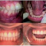 Photo: Before and After Invisalign