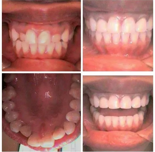 Photo: Before and After Invisalign and Single Visit CEREC Bridge