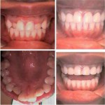 Photo: Before and After Invisalign and Single Visit CEREC Bridge