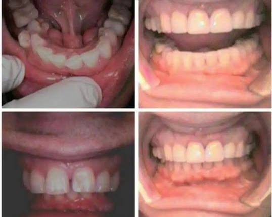 Photo: Before and After Invisalign