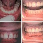 Photo: Before and After Invisalign