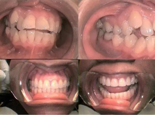 Photo: Before and After Invisalign