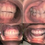 Photo: Before and After Invisalign