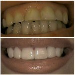 Photo: Before and After Opening the Bite and Using Veneers to Restore Teeth After Years of Grinding