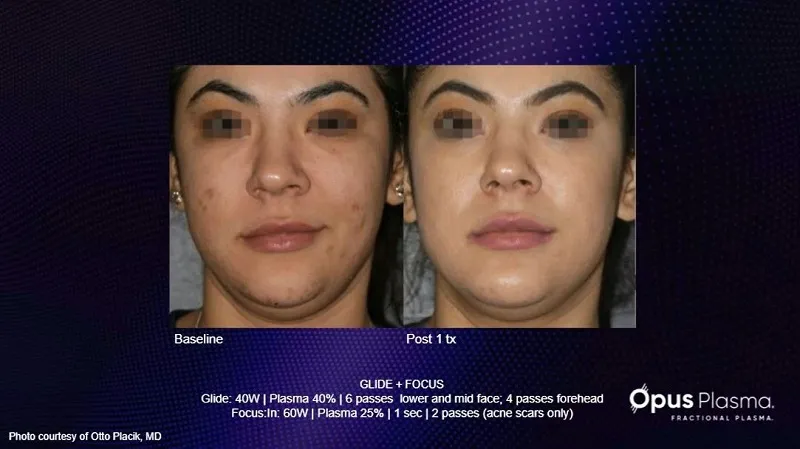 Before and after under-eye treatment — reduced puffiness and improved tone after 1 session