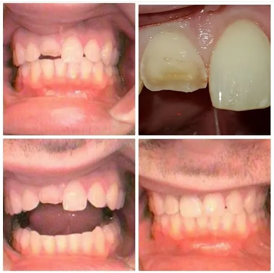 Photo: Before and After Invisalign Combined With Gingivoplasty