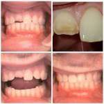Photo: Before and After Invisalign Combined With Gingivoplasty