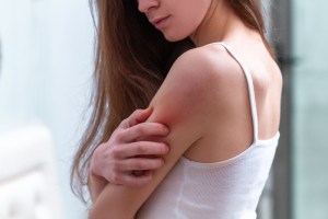 Woman rubbing her shoulder with psoriasis