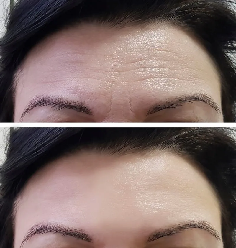 Before and after forehead treatment — diminished horizontal lines, smoother skin