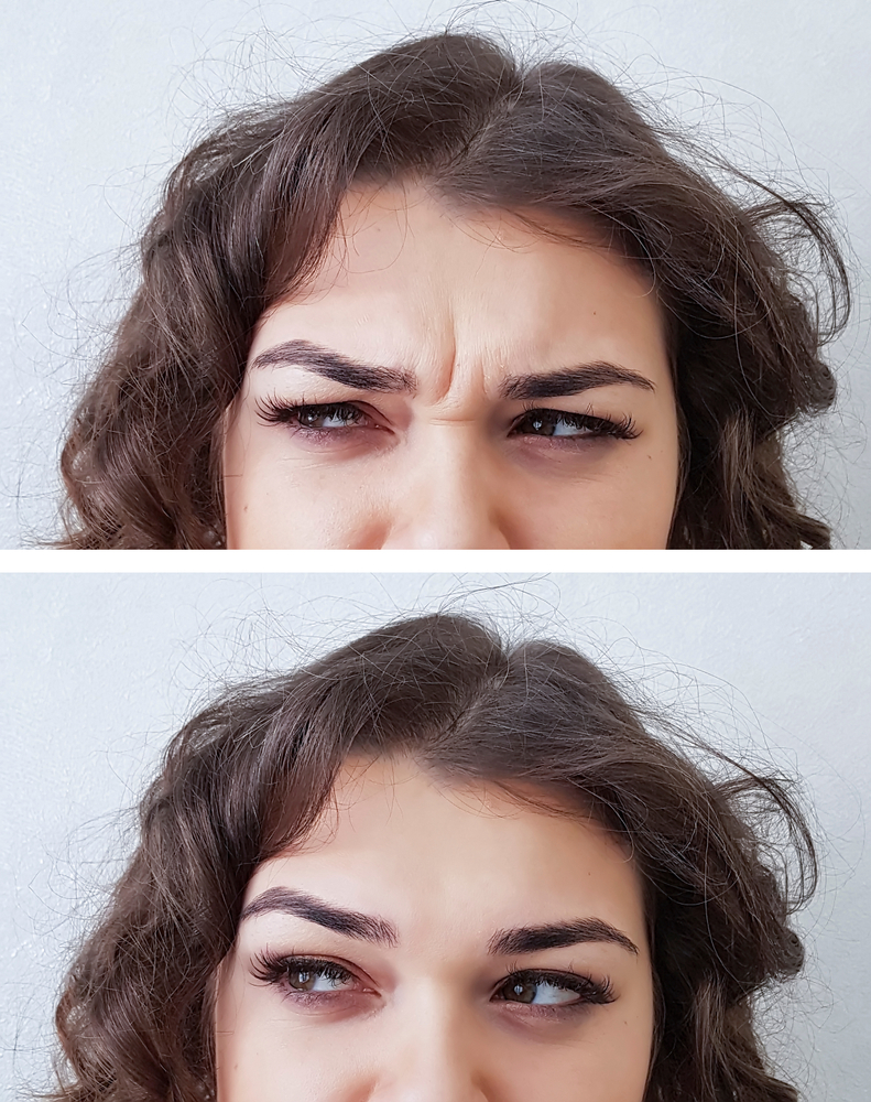 Before and after brow smoothing — relaxed frown lines, natural expression restored