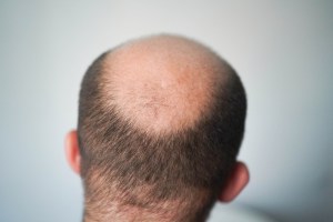 Hair Transplant Treatment VA