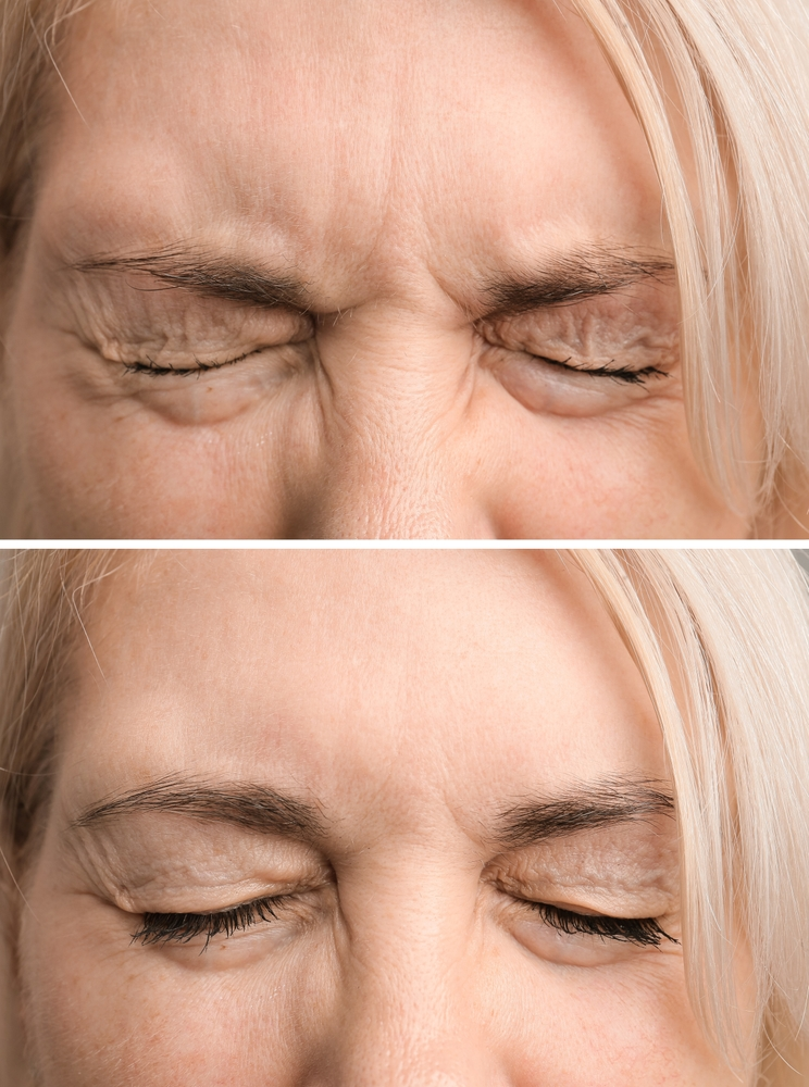 Before and after eye area treatment — reduced crow’s feet and smoother eyelid skin