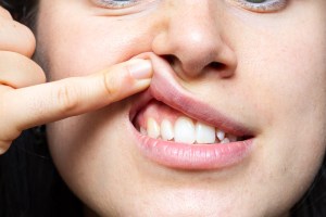 5 Signs to See an Emergency Dentist for Swollen Gums / Infection in Reston, Virginia