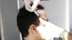 The Crown Comeback: Top-Rated Hair Restoration Cost and Side Effects in Ashburn, VA