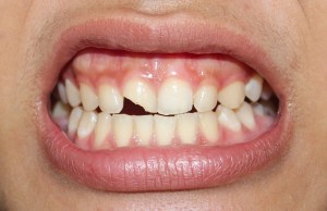 Smile SOS: Emergency Chipped Tooth Dental Appointments in Reston, VA