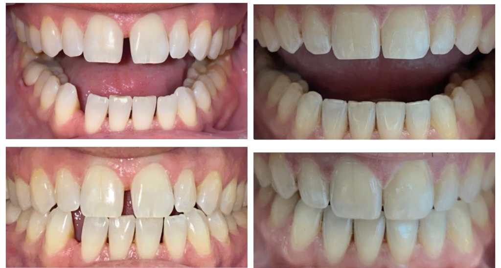 before and after of invisalign treatment