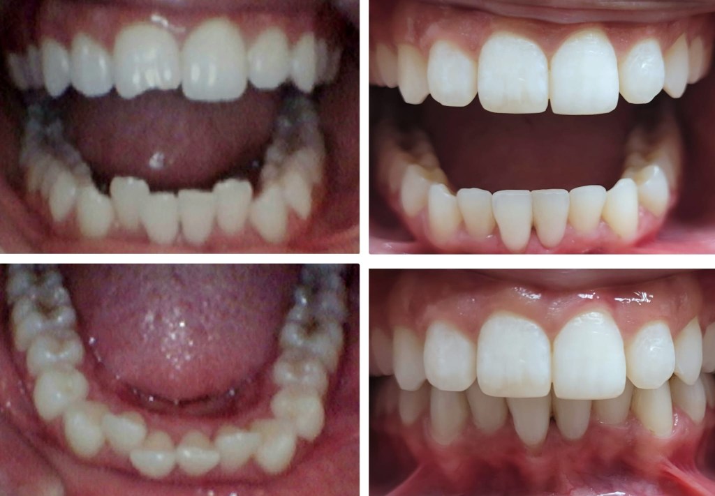 Patient before and after Invisalign treatment