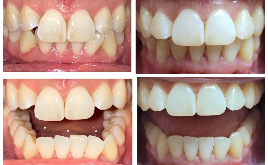 before and after of treatement from invisalign