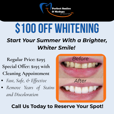 $100 off teeth whitening