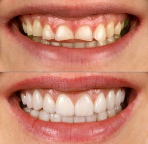 veneers before and afters